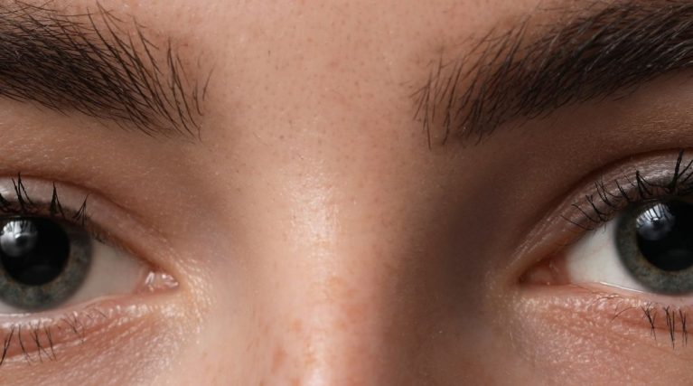 Kaş Arası (Glabella) Botoksu Kaş Arası (Glabella) Botoksu
