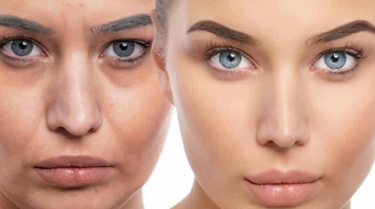 PRP (Platelet Rich Plasma) ile Cilt Gençleştirme kıbrıs PRP (Platelet Rich Plasma) ile Cilt Gençleştirme kıbrıs