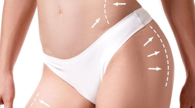 VASER Liposuction (Erkek Vücut Şekillendirme) kıbrıs