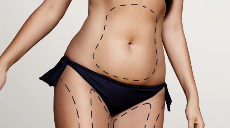 Vaser Liposuction Vaser Liposuction