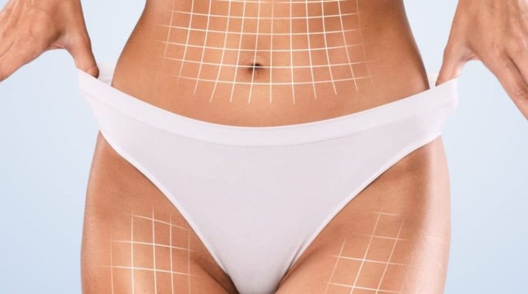 Vücut Estetiği (Body Contouring) kıbrıs Vücut Estetiği (Body Contouring) kıbrıs