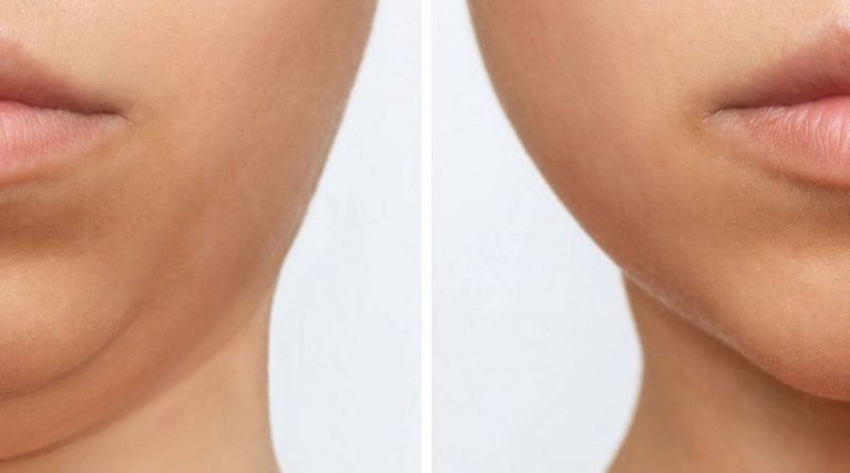 endolift endolift
