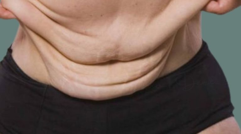 lowerbodylift-kktc lowerbodylift-kktc